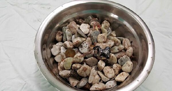 Мужчина пытался успокоиться, поедая килограммы камней и монет Мужчина пытался успокоиться, поедая килограммы камней и монет - Sputnik Азербайджан