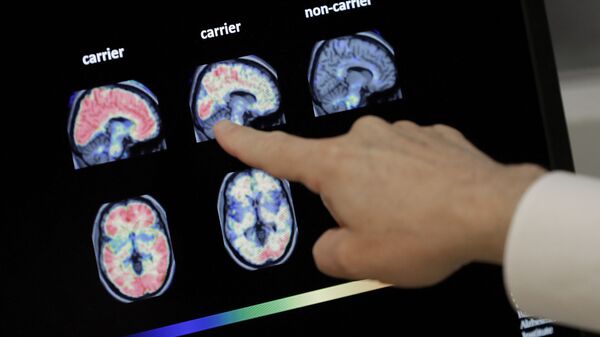Доктор Уильям Берк осматривает сканирование мозга ПЭТ в Баннерном институте Альцгеймера в Фениксе. - Sputnik Azərbaycan