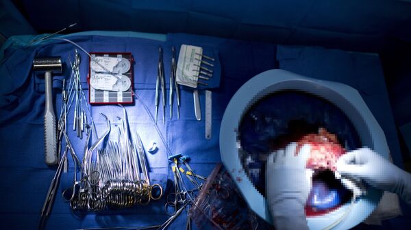 Трансплантация почки, фото из архива - Sputnik Азербайджан