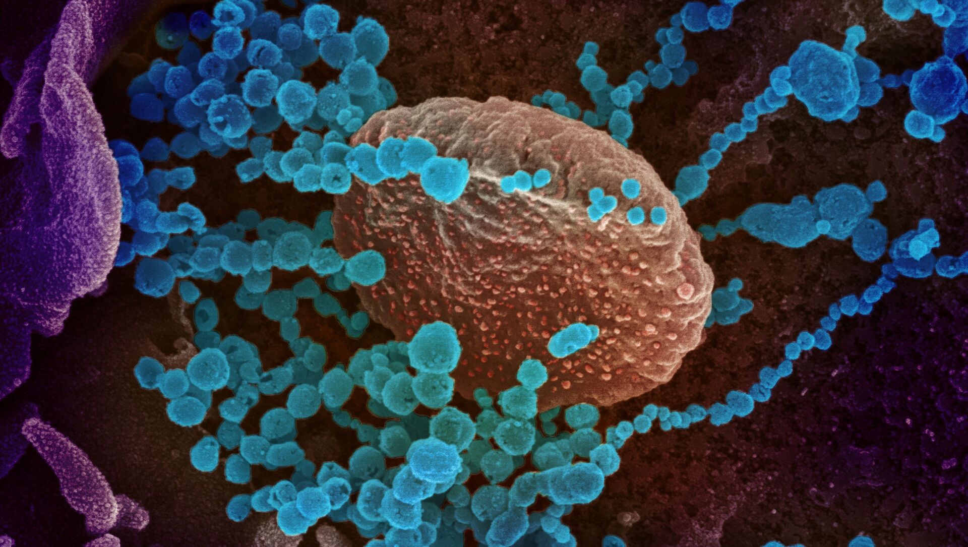Вид на зараженную коронавирусом  клетку под микроскопом  - Sputnik Азербайджан, 1920, 24.06.2021
