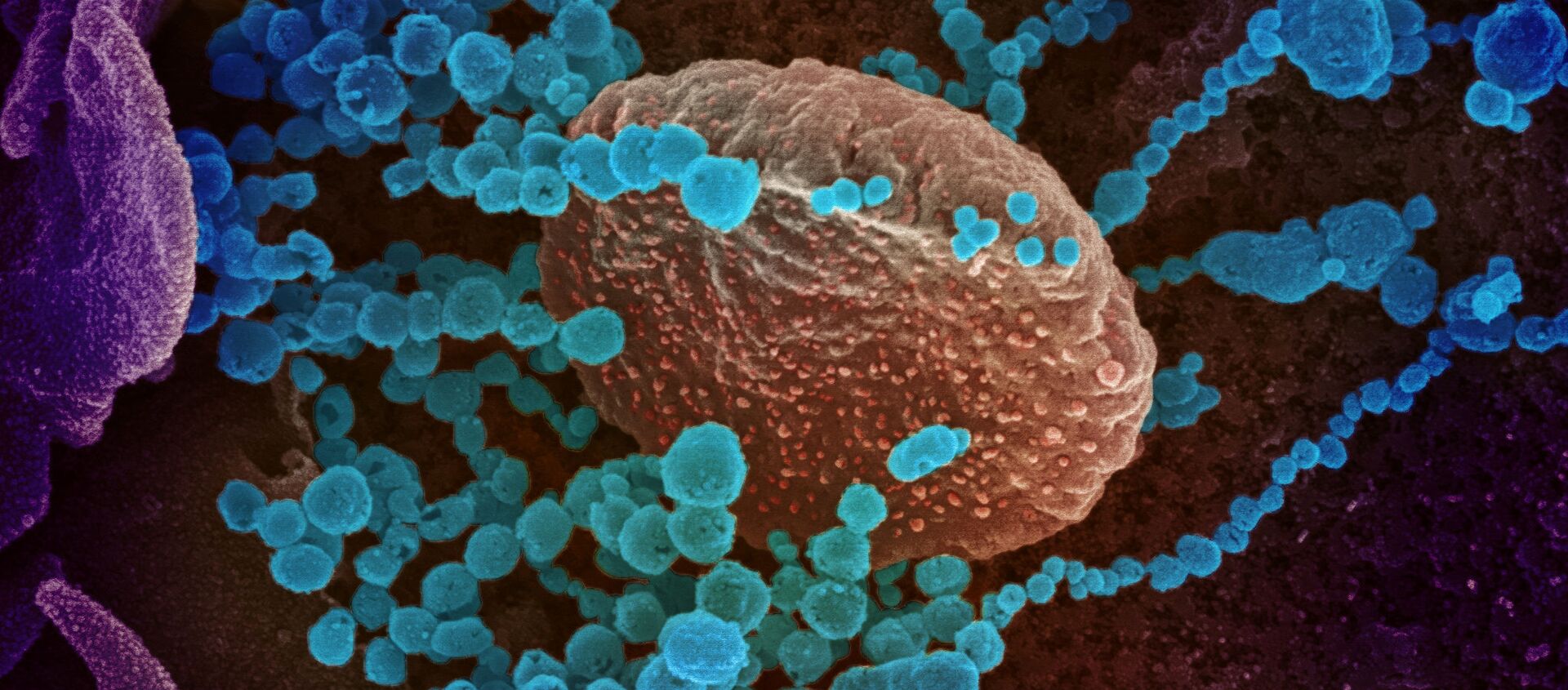 Вид на зараженную коронавирусом  клетку под микроскопом  - Sputnik Azərbaycan, 1920, 17.02.2021