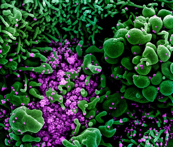 An undated colorized scanning electron micrograph of an apoptotic cell (green) heavily infected with SARS-COV-2 virus particles (purple), also known as novel coronavirus, the virus which causes COVID-19, isolated from a patient sample - Sputnik Азербайджан